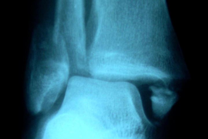Röntgenbild eines Knöchelbruches (Bimalleolarfraktur Weber B)